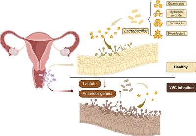 Vulvovaginal candidiasis and vaginal microflora interaction: Microflora changes and probiotic therapy